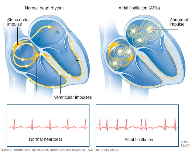 Atrial fibrillation