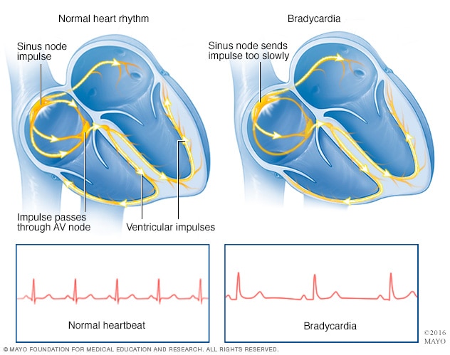 Bradycardia