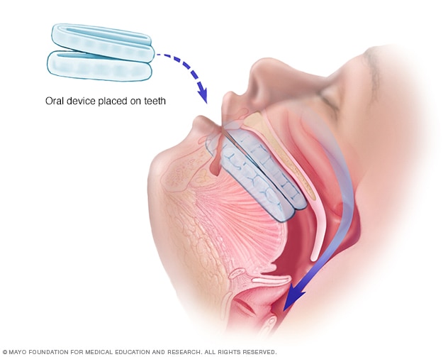 An oral device