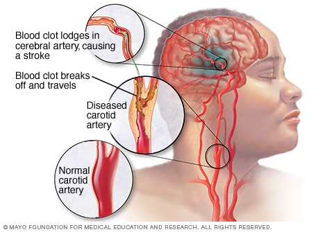 Ischemic stroke