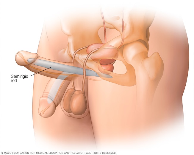 Semirigid penile implant