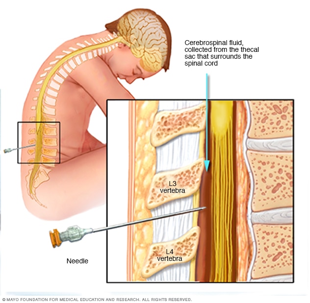 Lumbar puncture, also known as a spinal tap