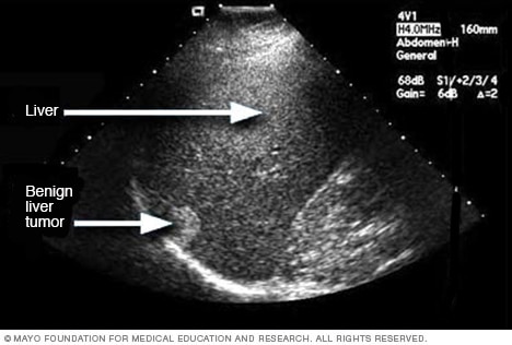 Ultrasound image of a liver tumor