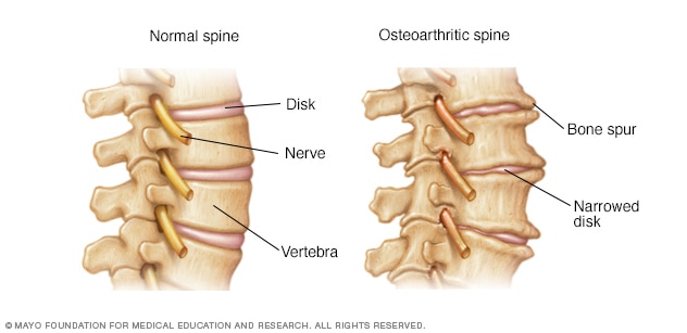 Bone spurs on spine