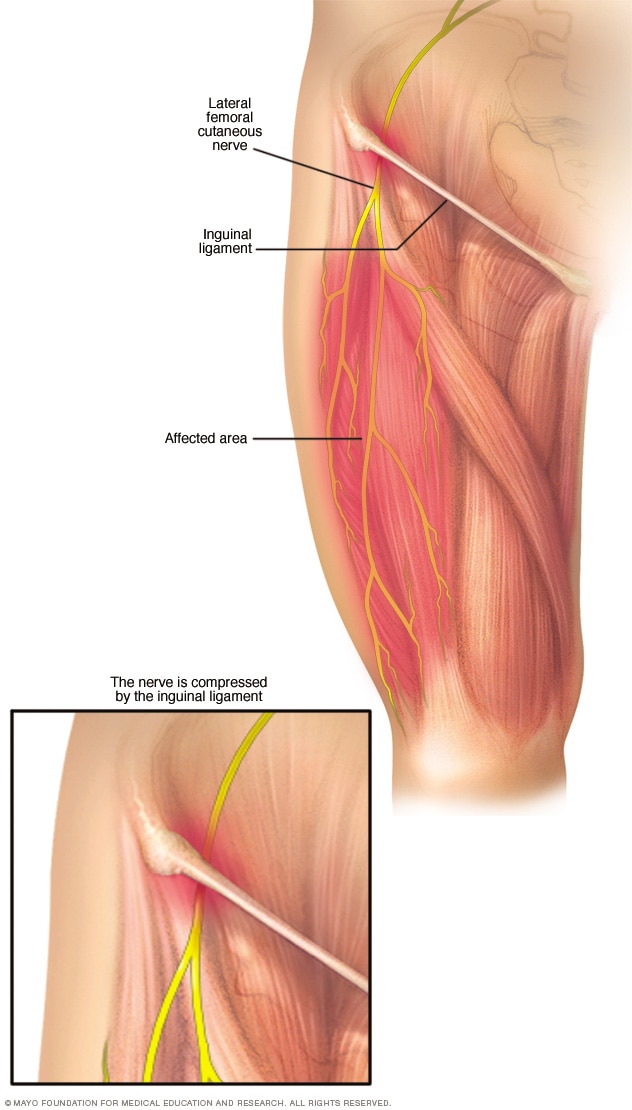 Meralgia paresthetica