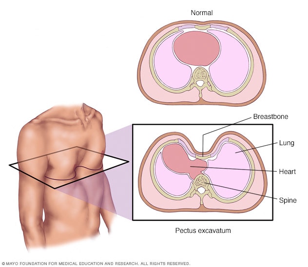 Breastbone depression 