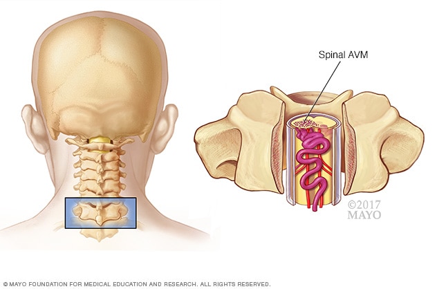 Spinal arteriovenous malformation (AVM)