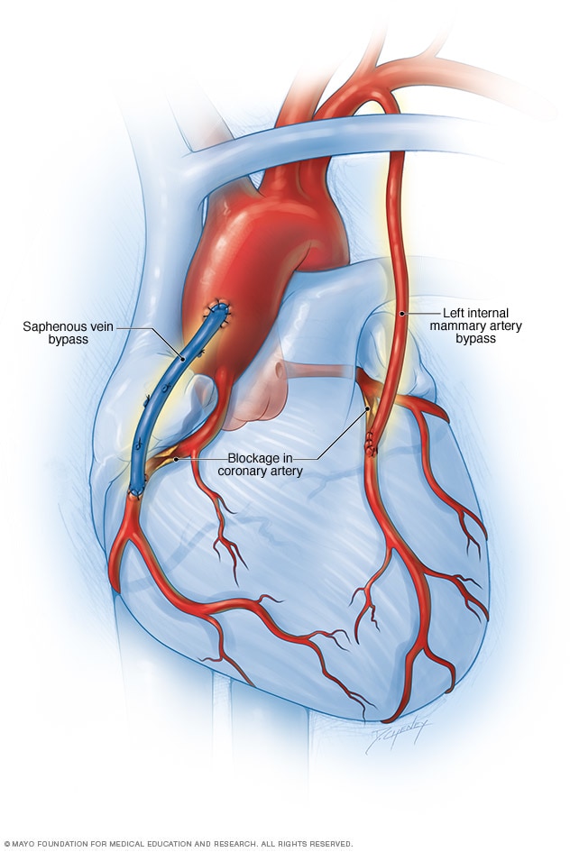 Coronary artery bypass surgery