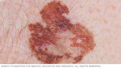 Melanoma with irregular border