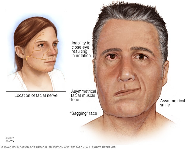 OT Observations: Bell's Palsy Treatment with FES and Heat