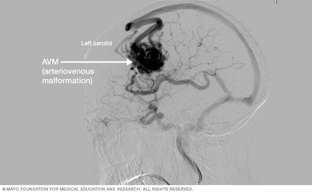 Cerebral angiogram showing brain AVM