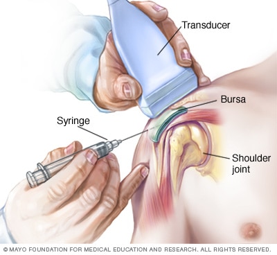 Injection into shoulder bursa