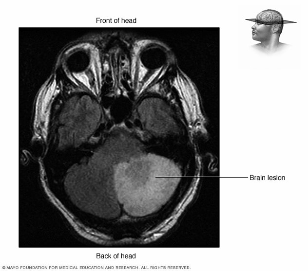 MRI showing a brain lesion