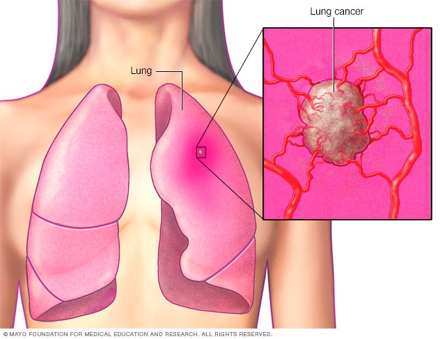 Lung cancer