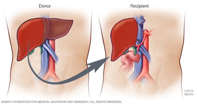 Living-donor liver transplant