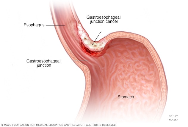 Gastroesophageal junction cancer