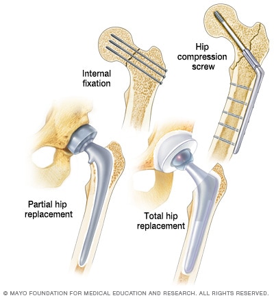 Hip fracture repair techniques