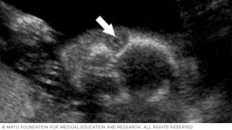 Ultrasound image showing the lens of the eye