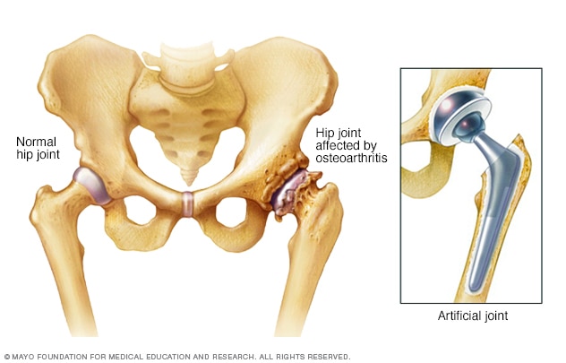 Hip affected by osteoarthritis before and after hip replacement