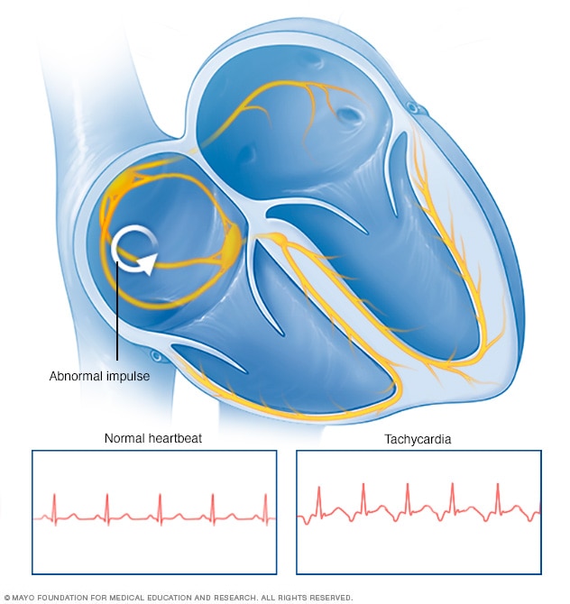 Tachycardia heartbeat