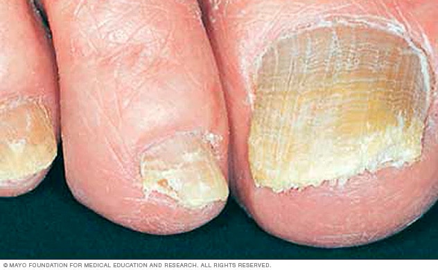 Nail fungus