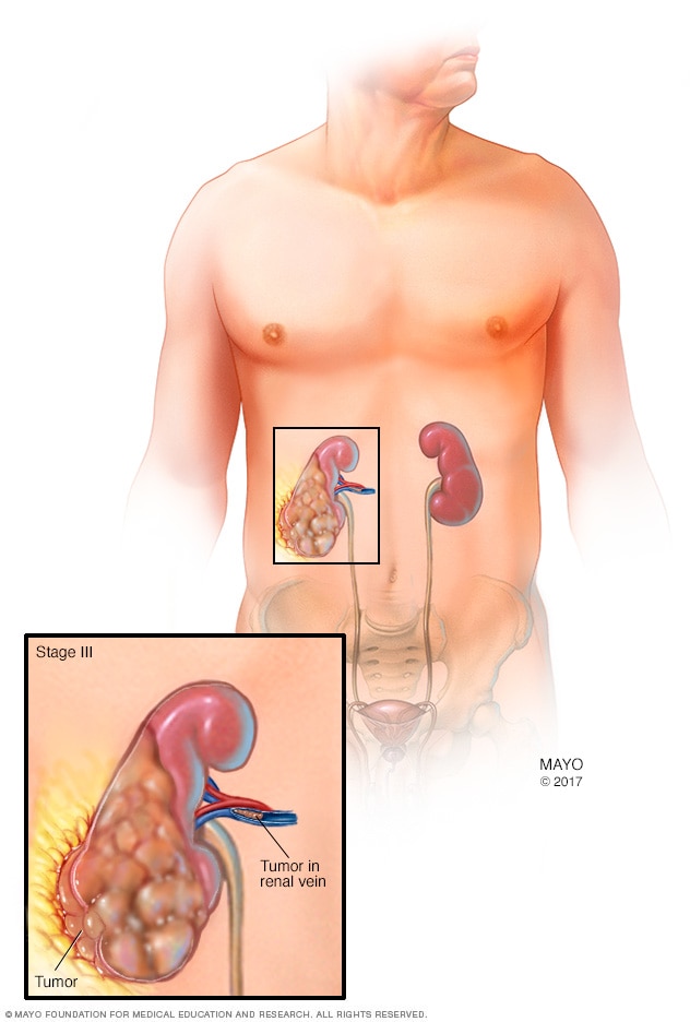 Stage III kidney tumor
