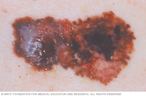 Melanoma