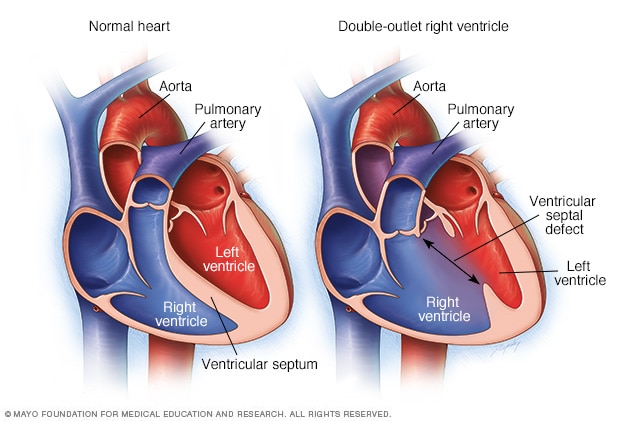 Typical heart and heart with double-outlet right ventricle