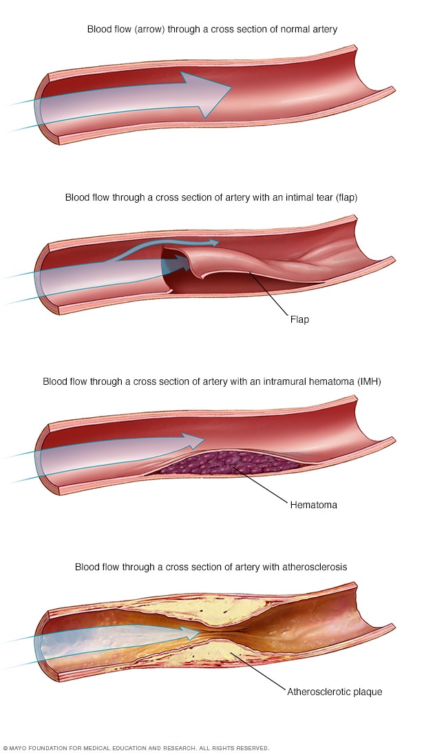 Blood flow in arteries in SCAD