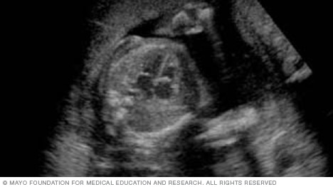 Ultrasound image showing the chambers of a fetus