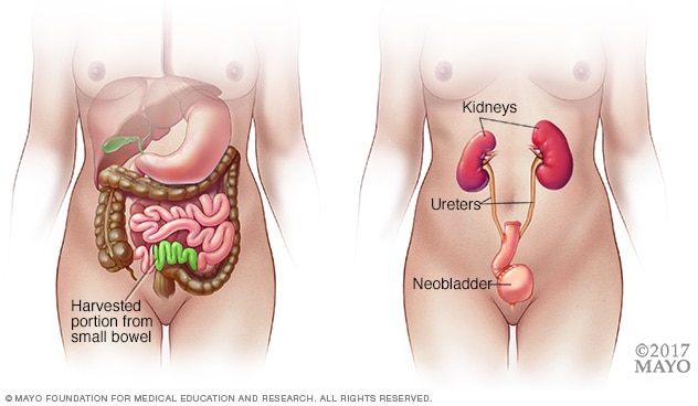 Part of small intestine used for neobladder reconstruction