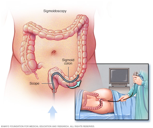 Flexible sigmoidoscopy exam