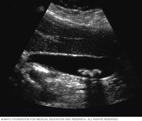 Ultrasound image of gallstones