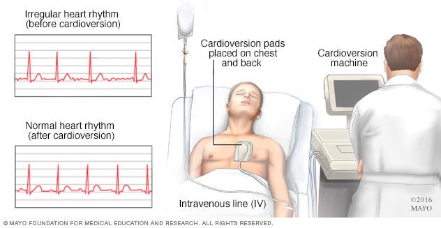 Person undergoing cardioversion 