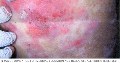 Dystrophic epidermolysis bullosa prevents the layers of skin from joining as usual.