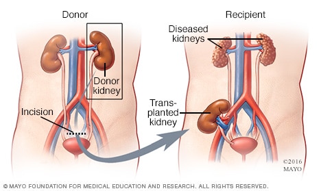 Living kidney donor laparoscopic nephrectomy