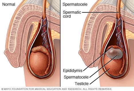 Spermatocele