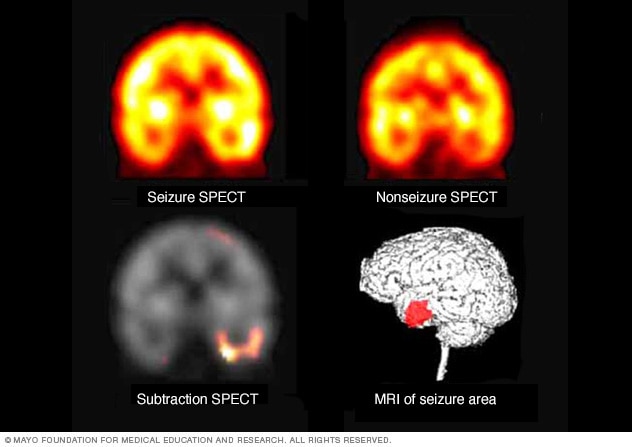 A set of brain images shows a nonseizure SPECT, a seizure SPECT and a subtraction SPECT coregistered to MRI.