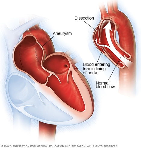 Aortic aneurysm and aortic dissection