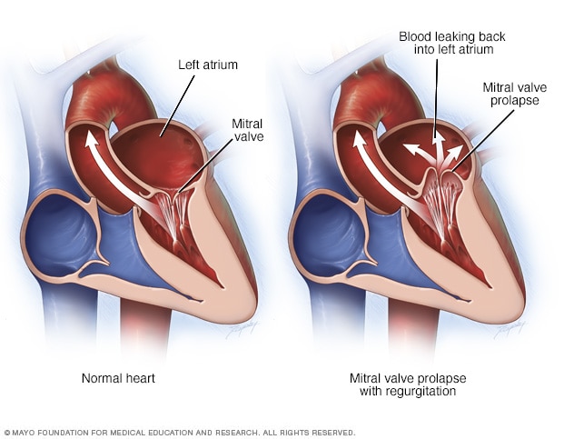 Mitral valve prolapse and regurgitation