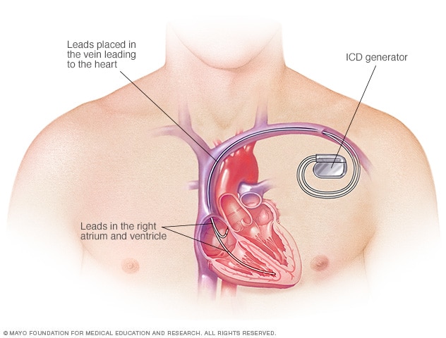 Implantable cardioverter-defibrillator (ICD)