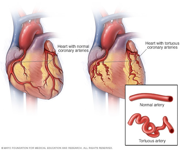A healthy heart and a heart with tortuous arteries