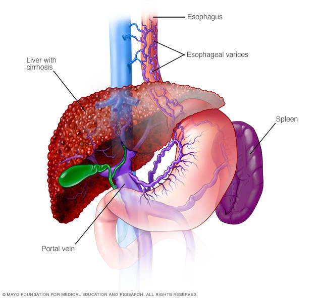 Esophageal varices