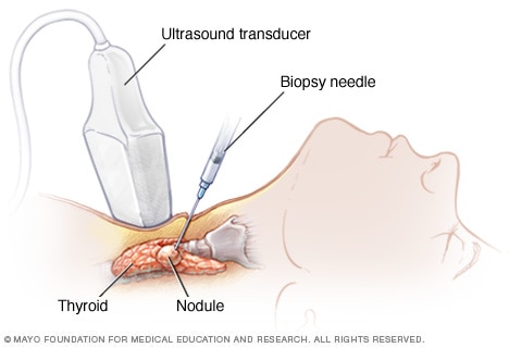 Needle biopsy of thyroid cancer 