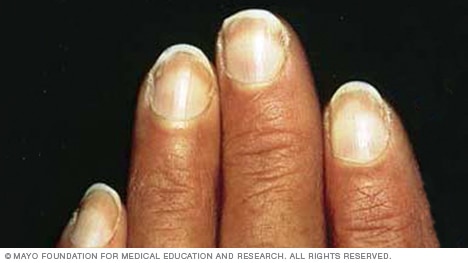 An example of fingernails with Terry