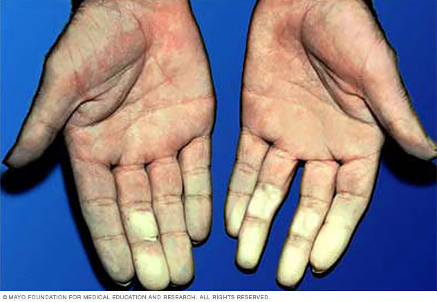 Hands affected by Raynaud