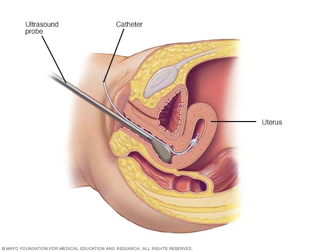 Hysterosonography