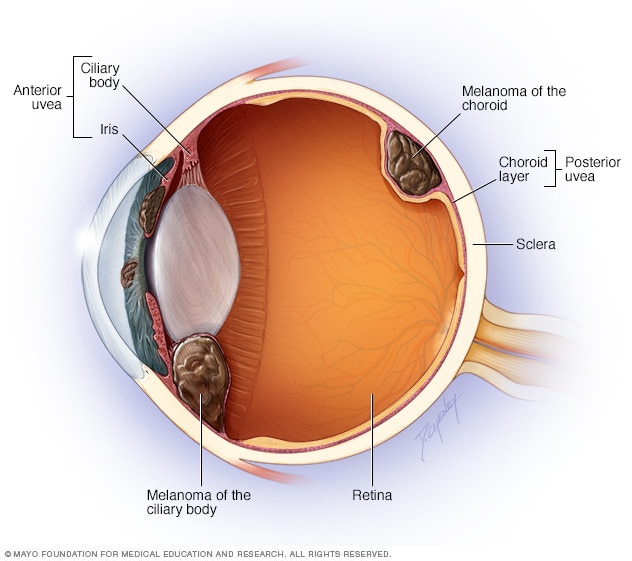 Illustration showing where eye melanoma occurs

