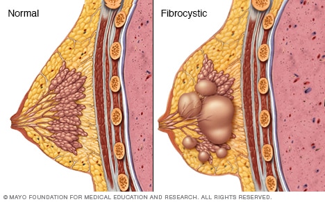 Normal breast vs. fibrocystic breast