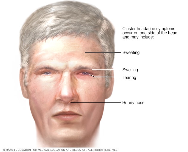 Cluster headache symptoms affecting the face